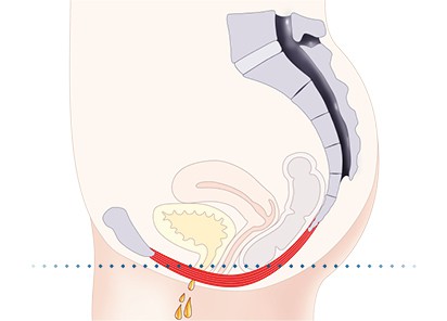 Pelvic-Floor Muscle Repair 5 Pelvic floor muscles Tilbury
