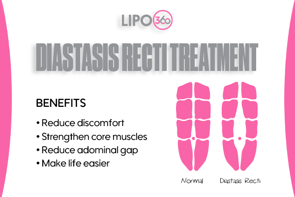 Revolutionising Muscle Repair: The Power of LIPO360 Body Sculpt Post-Injury 5 diastasis recti treatment Tilbury