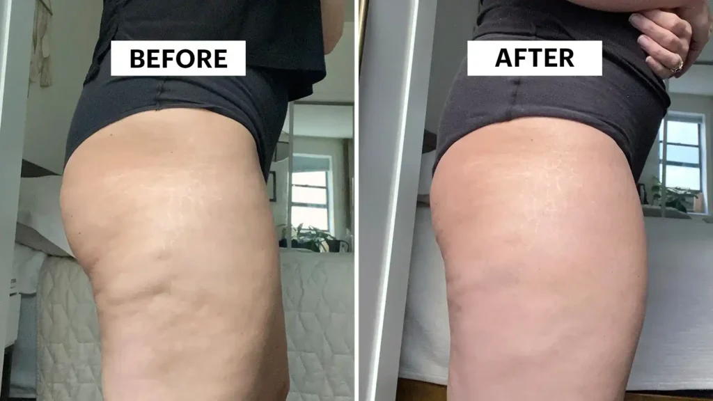 Sculpting Your Bum: Can Toning Exercises Really Reduce Cellulite? 1 Do Toning Exercise Tilbury Really Tackle Cellulite?
